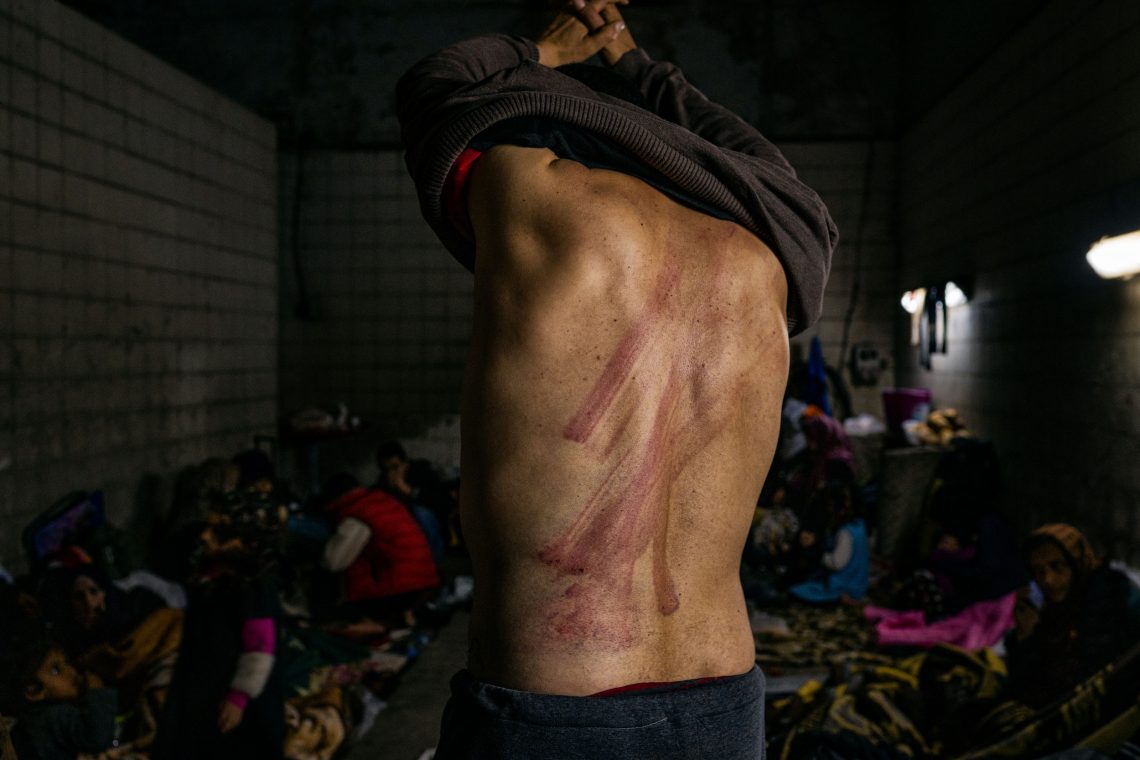 Wunden auf dem Rücken eines marokkanischen Geflüchteten in der Türkei