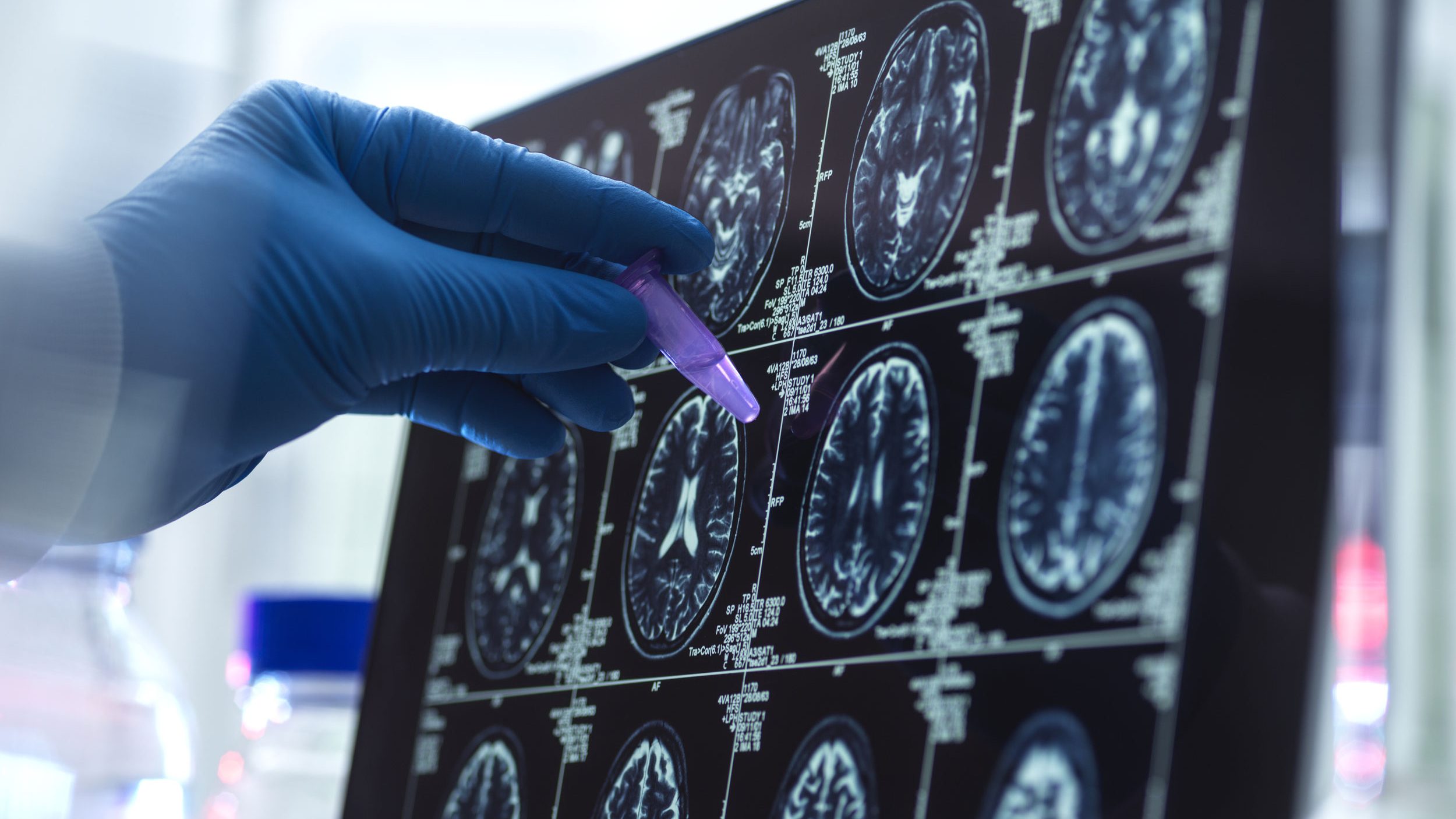 Das Bild zeigt Scans von Gehirnen in einem Labor. Das Bild illustriert einen Artikel über ein neues Medikament gegen Alzheimer.